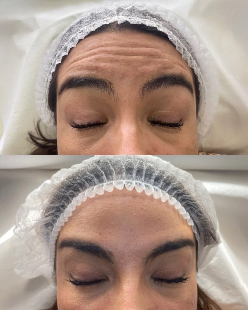botox 1