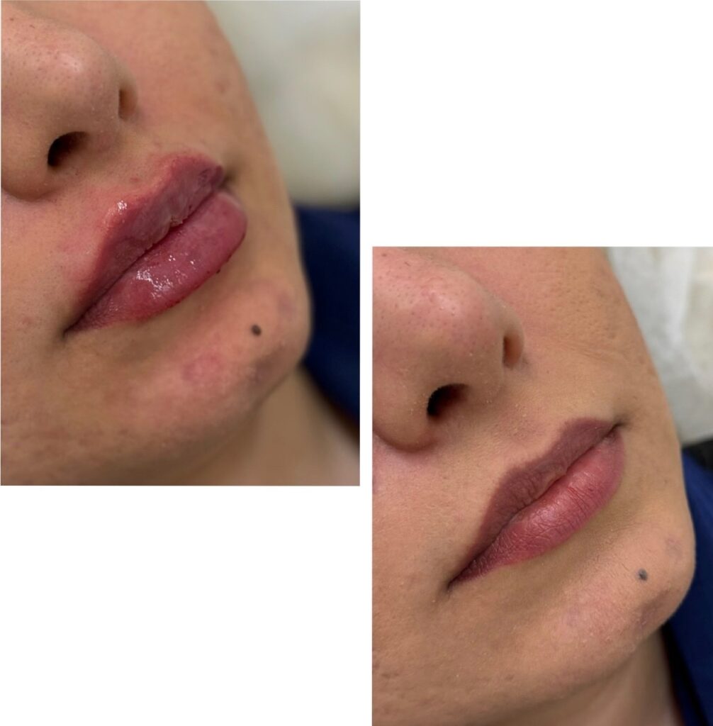 botox