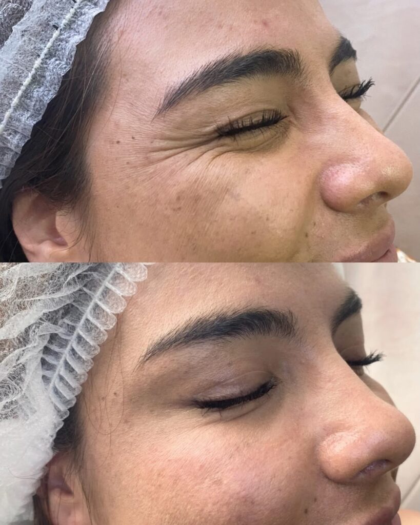 botox 2