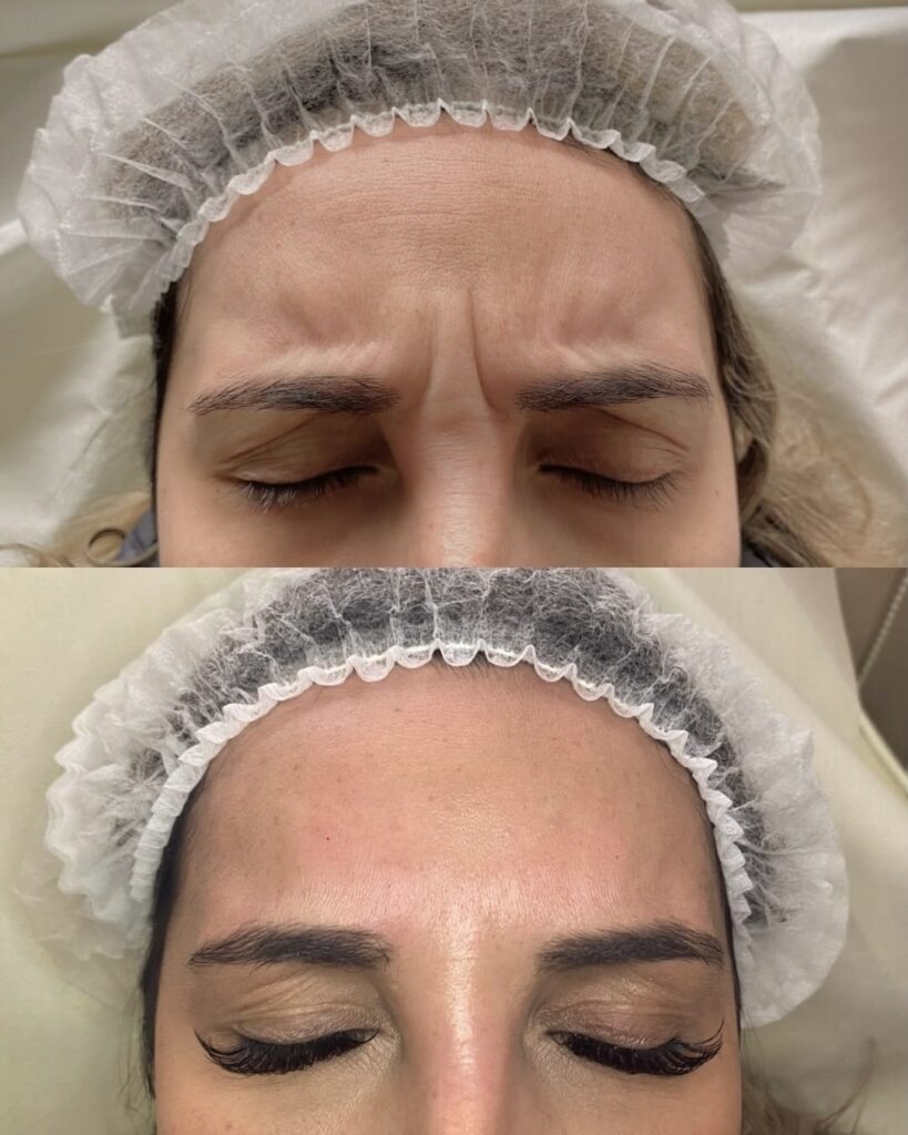 botox 3