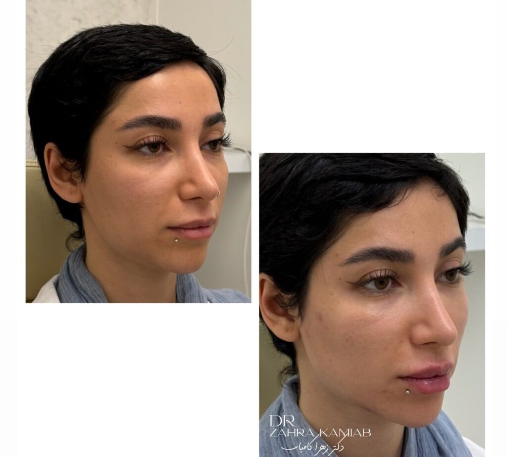 botox2