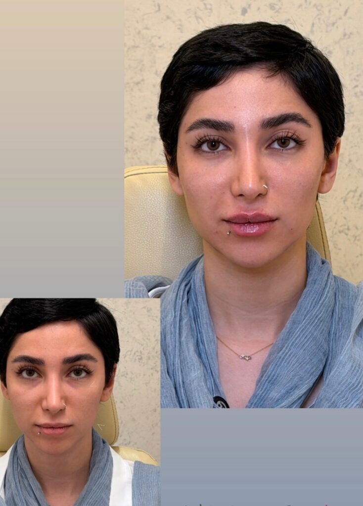 botox4