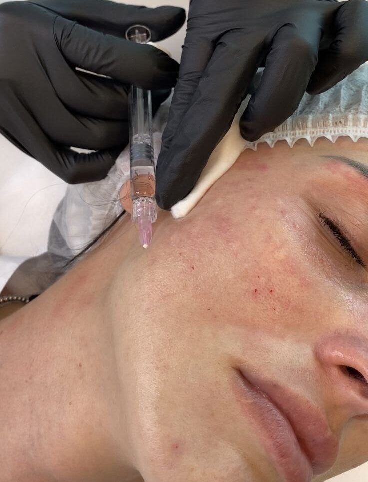 مزوژل چیست و چه کاربردی دارد